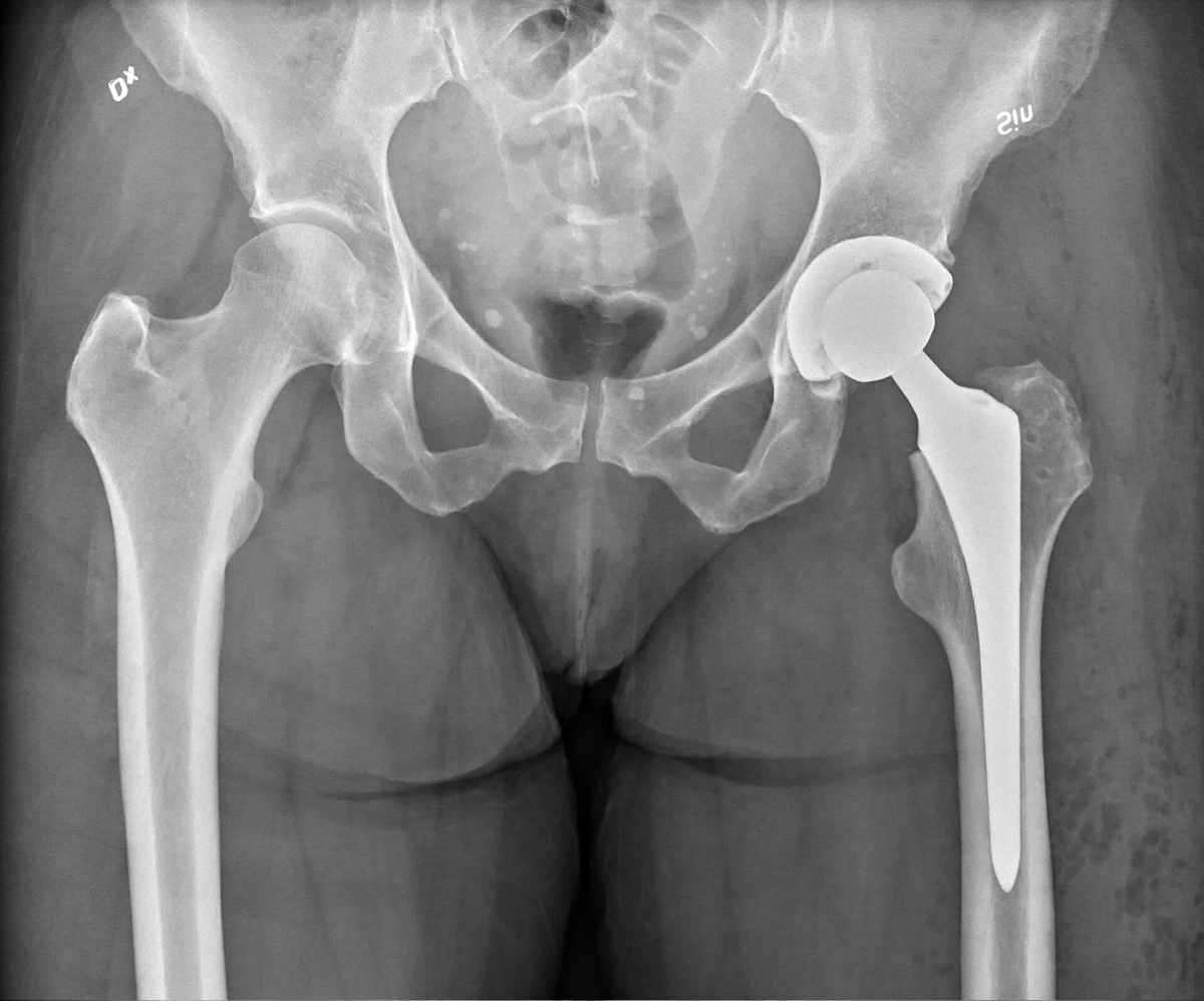 Hip Replacement Surgery (Total Hip Arthroplasty) - Orthopaedic Surgeon Johannesburg, South Africa