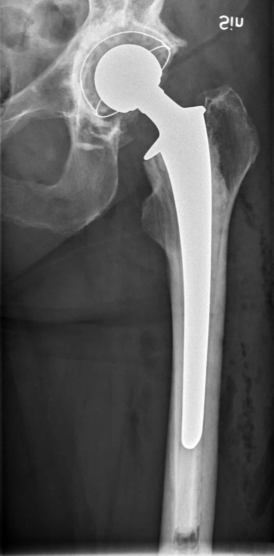 Hip Replacement Surgery (Total Hip Arthroplasty) - Orthopaedic Surgeon Johannesburg, South Africa