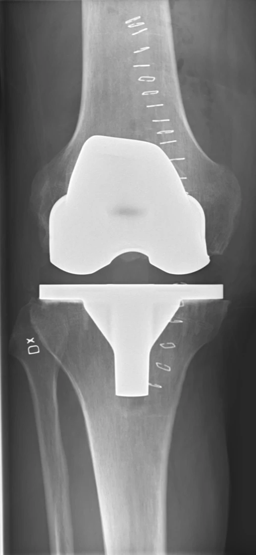 Knee Replacement Surgery (Total Knee Arthroplasty) - Orthopaedic Surgeon Johannesburg, South Africa