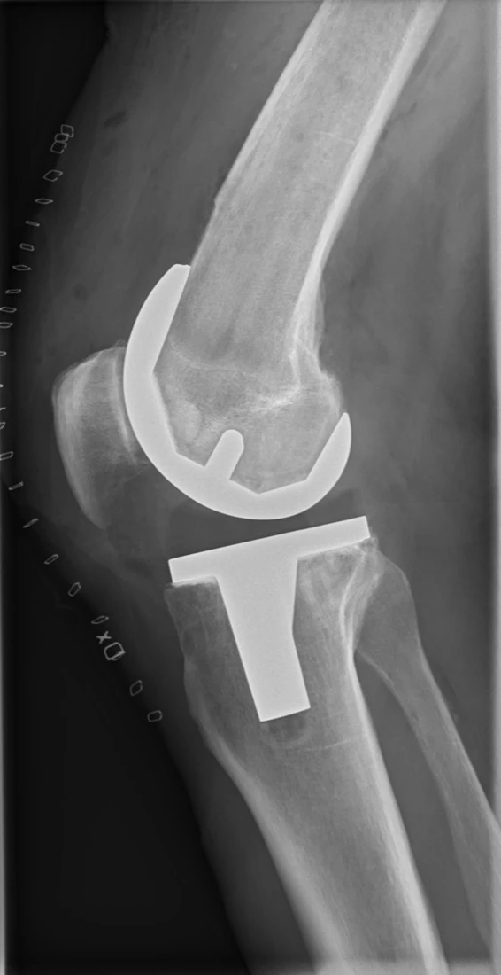 Knee Replacement Surgery (Total Knee Arthroplasty) - Orthopaedic Surgeon Johannesburg, South Africa